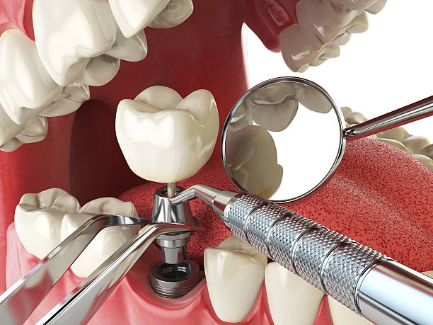 Best Emergency Dentist for Knocked-Out Tooth in Northlake, IL